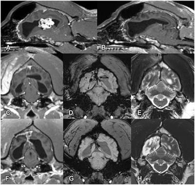 Case report: Intraventricular tumor removal using transcallosal approach and follow-up in three dogs